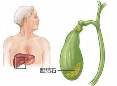 民间打结石的方子